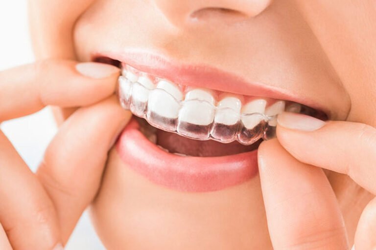 Sports Dentistry through transportable aligners