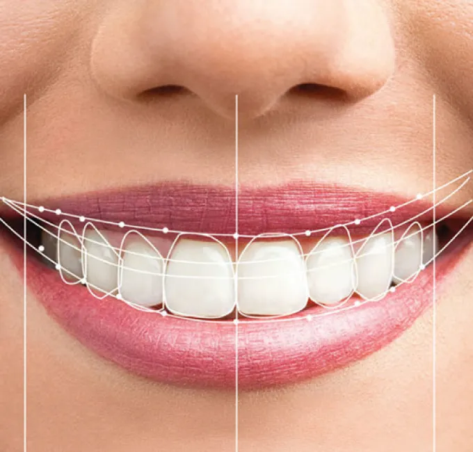 smile-makeover