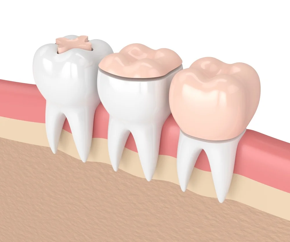 conservative yet powerful alternatives to traditional fillings through inlays, onlays, and overlays.
