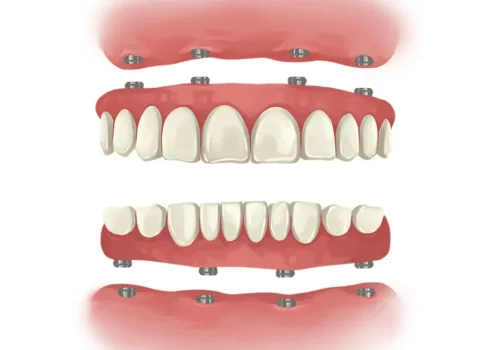 Full Mouth Rehabilitation in Vadodara | Complete Smile Makeover Full Mouth Rehabilitation — a comprehensive and customized treatment plan to restore the health, function, and appearance