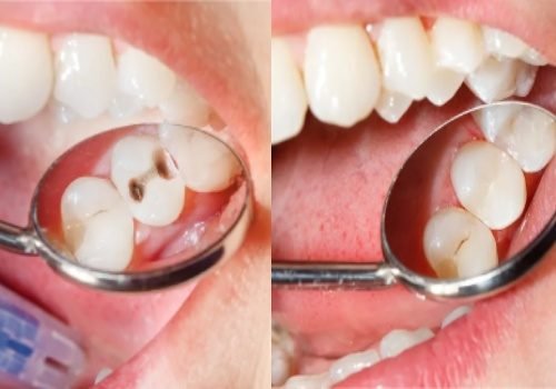Composite Filling – Natural-Looking Tooth Repair Composite fillings in Vadodara, Tooth-colored , fillings Vadodara, White Fillings