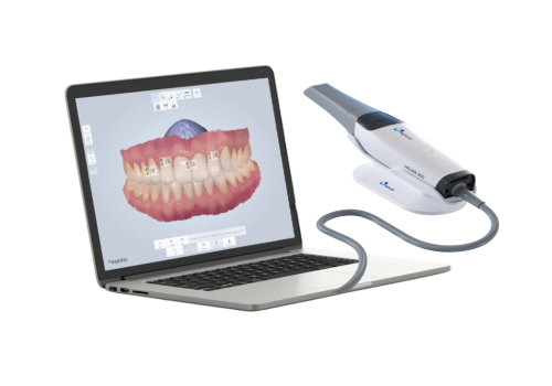 Our Digital Impression technology captures precise 3D images of your teeth and gums using a comfortable