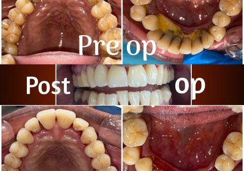 Oral Prophylaxis Oral prophylaxis is a professional cleaning procedure