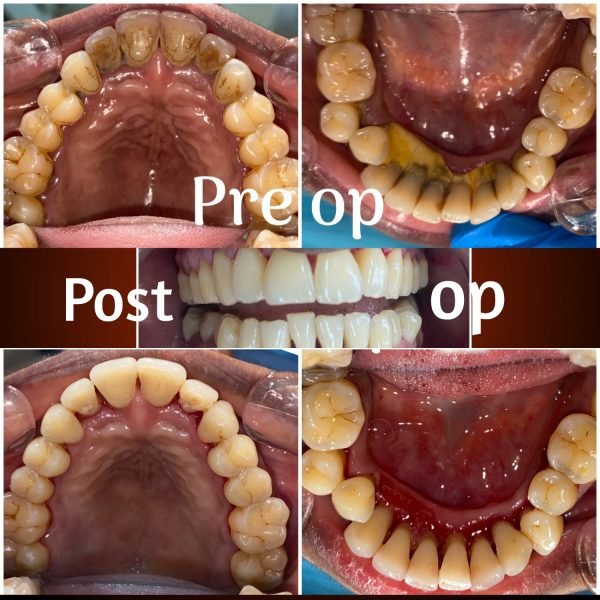 Oral prophylaxis is a professional cleaning procedure