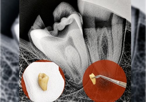 Painless Wisdom Tooth Removal Painless Wisdom Tooth Removal, we believe that wisdom tooth removal should be a smooth, comfortable, and stress-free experience