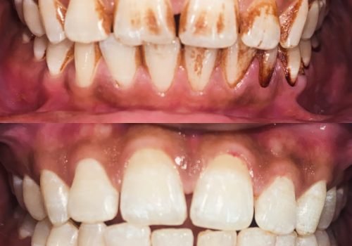 Professional Teeth Cleaning Outer Professional Teeth Cleaning Outer