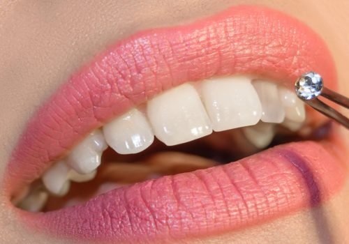 Dental Jewellery Dental Jewellery Add Sparkle to Your Smile