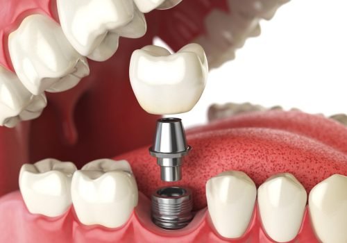 Dental Implants – Permanent Solution for Missing Teeth Dental Implants – Permanent Solution for Missing Teeth give you Pure Dental Solutions