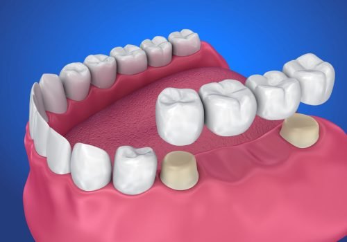 Dental Crowns & Bridges – Restore Strength and Smile high-quality dental crowns and bridges to restore damaged teeth and replace missing ones