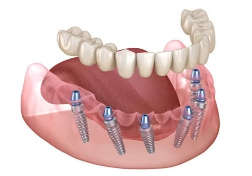 Dental implants surgery is a procedure that replaces tooth roots with metal