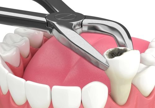 Tooth Extraction – Safe, Painless, & Gentle Care safe and painless tooth extraction services using advanced techniques