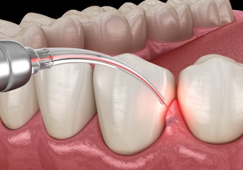 Discover the latest in gentle dental care with Laser Dentistry