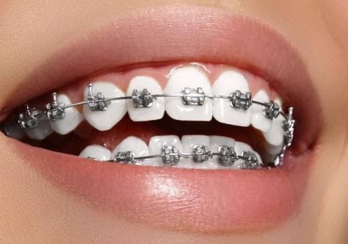 Orthodontic Care Orthodontic Care – Straighten Your Teeth metal Ceramic Braces Product