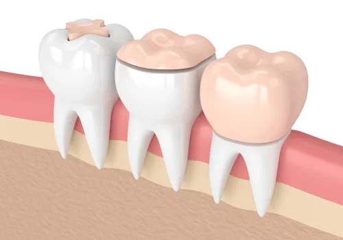 Inlay, Onlay, and Overlay Treatments conservative yet powerful alternatives to traditional fillings through inlays, onlays, and overlays.