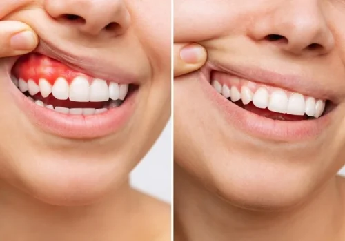 Gummy Smile Correction Gummy Smile Correction – Balance Your Smile Beautifully