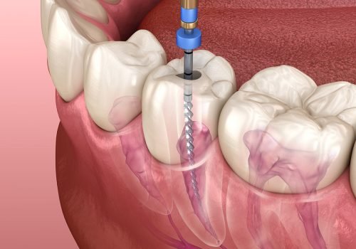 Painless Root Canal & Re-Root Canal Treatment Microscopic Root Canal & Re-Root Canal Treatments Painless Root Canal & Re-Root Canal Treatment