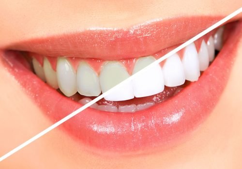 Teeth Whitening – Brighten Your Smile Instantly safe and effective professional teeth whitening treatments to remove deep stains and discoloration